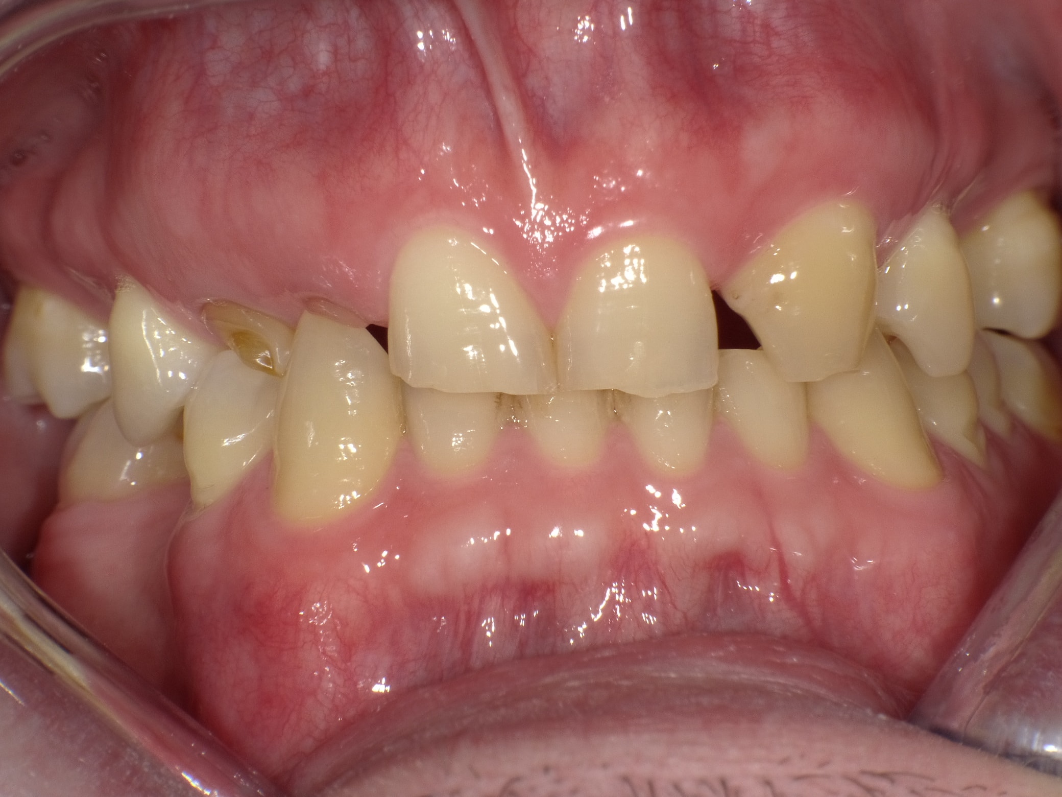 Teilweise Nichtanlage bleibender Zähne mit teilweise noch vorhandenen Milchzähnen, abgesunkener, lückiger Bisslage
